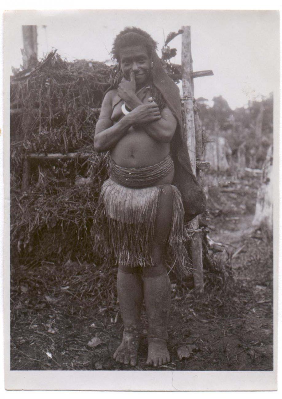 BD/38/5 - 
Woman with elephantiasis.
