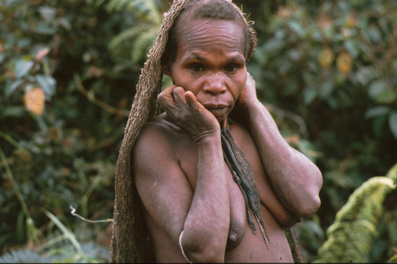 BD/166/95 - 
Portrait of woman with missing phalanges
